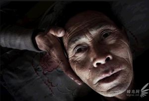 河南省某村，66岁的赵丙坤04年患上食道癌，经过二次开刀，治疗费已达20余万元，病情进入晚期，每天在发烧，等待死亡2009年4月7日