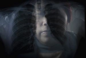 吴庄，43岁的高凤菊在去年查出肺癌，如今她的右半肺已被切除了三分之一。